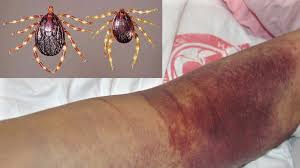 Uganda Confronts Dual Health Challenges as Malaria Surges Amid Healthcare Strain