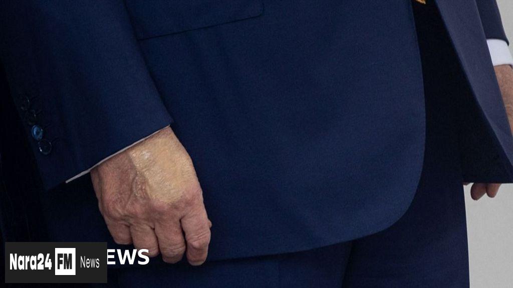 White House Reveals Trump Diagnosis with Vein Condition